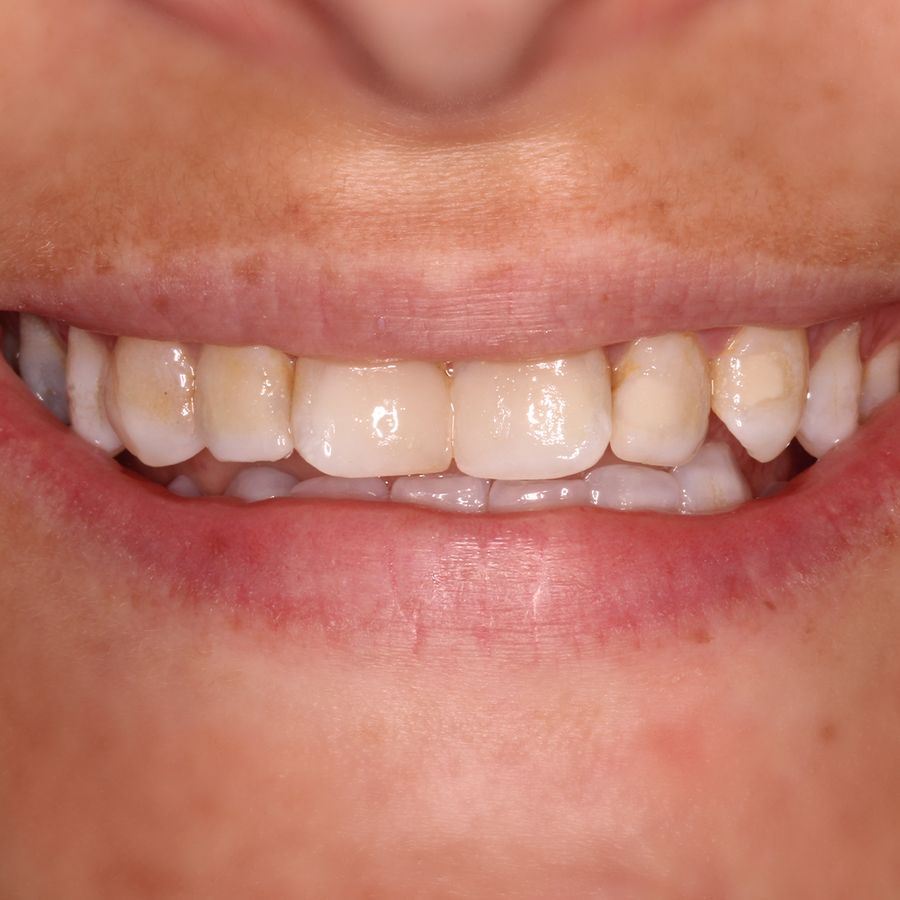 Composite veneers - before - 3Dental - Dublin & Limerick